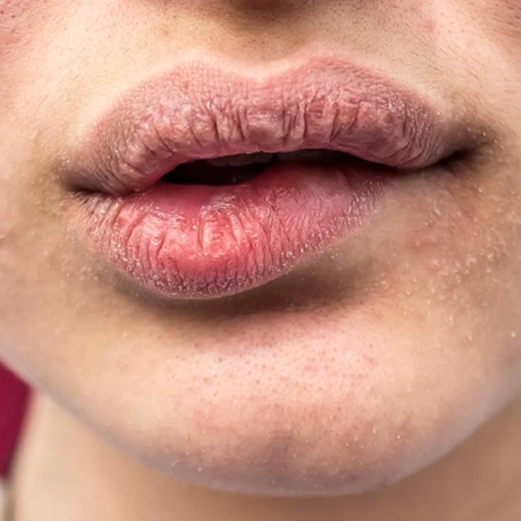 Close de lábios ressecados.