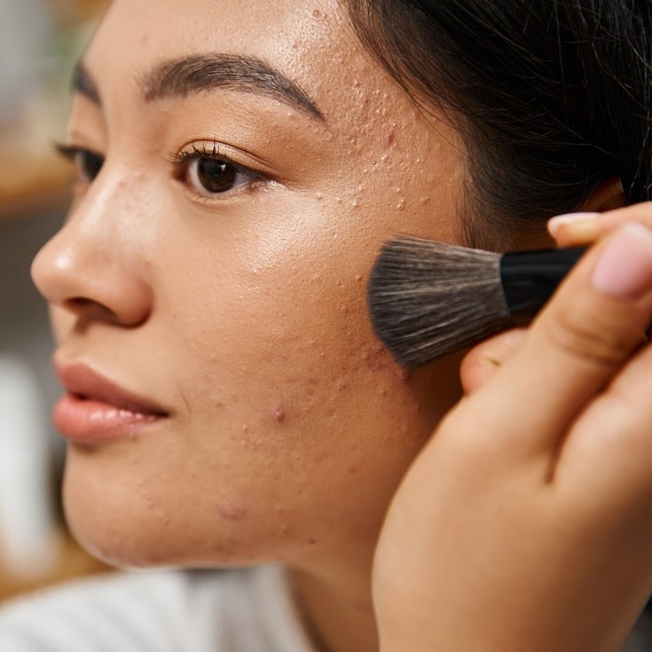 Mulher asiática aplicando maquiagem em pele acneica.