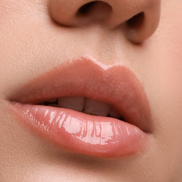 Mulher com gloss com ácido hialurônico nos lábios.