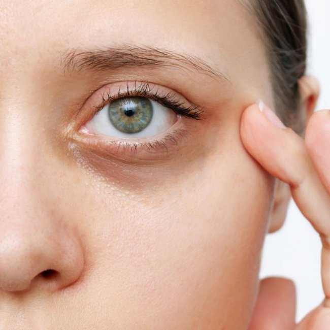 Olhos de uma mulher caucasiana com olheiras escurecidas
